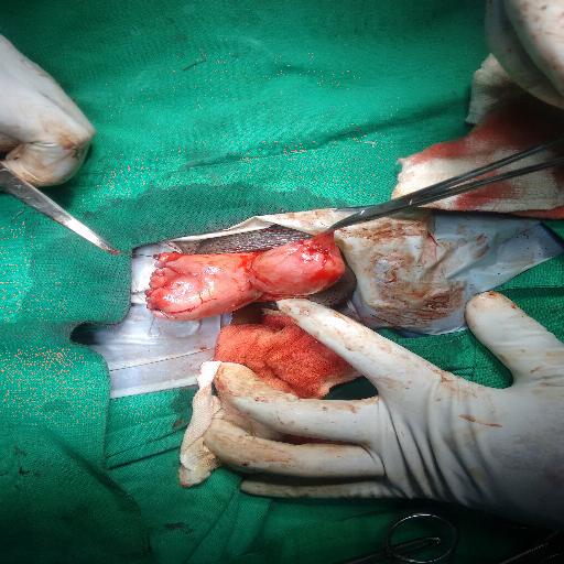 Subcapsular orchidectomy